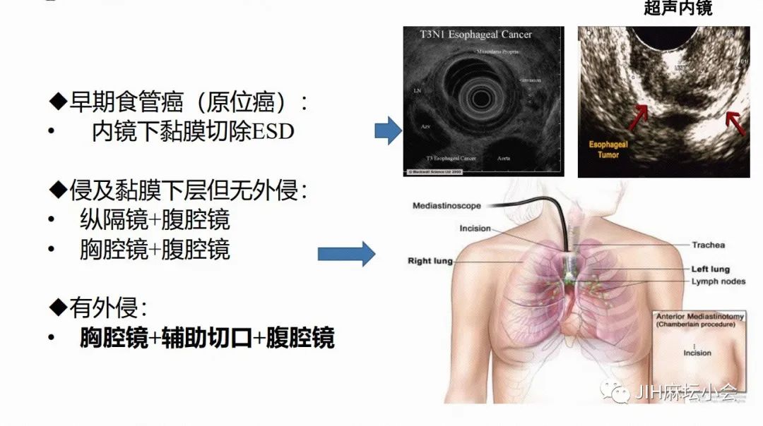 食管癌微(wēi)創手術(shù)的(de)麻醉管理(lǐ)(圖2)