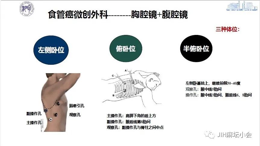 食管癌微(wēi)創手術(shù)的(de)麻醉管理(lǐ)(圖3)